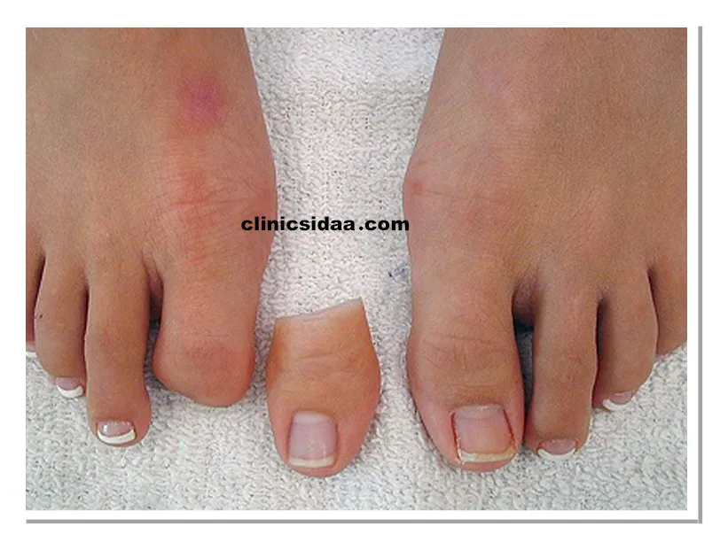 انواع پروتز انگشت پا