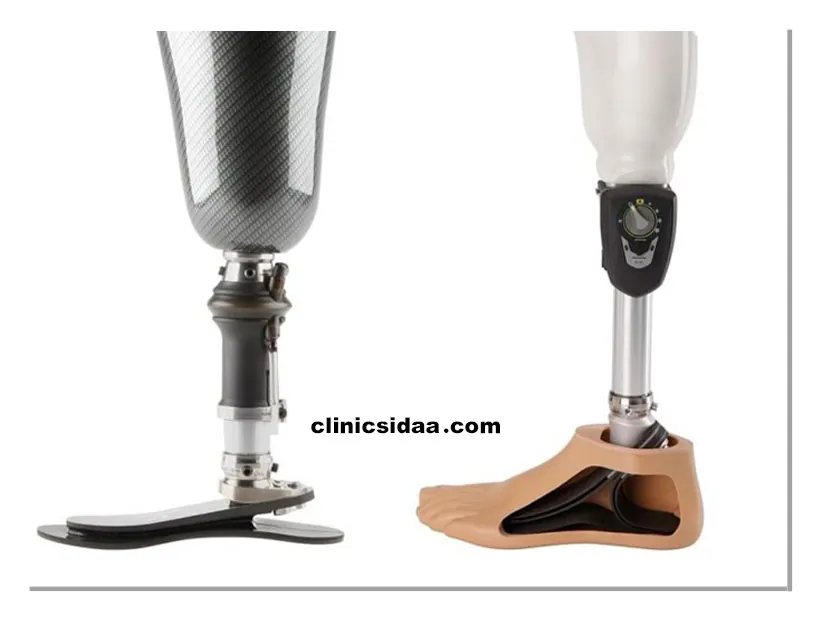 پروتز پا چیست؟ معرفی کامل، کاربردها و نکات کلیدی 5 اجزای پروتز پا چیست