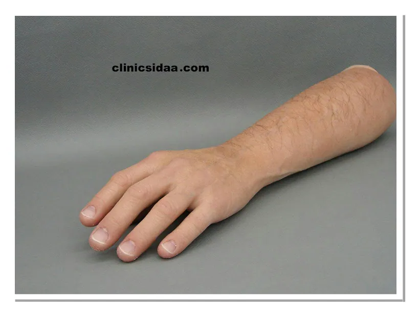 انواع پروتز مچ دست