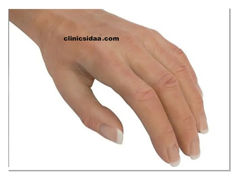 چه مصدومیت هایی باعث قطع مچ دست می شوند؟