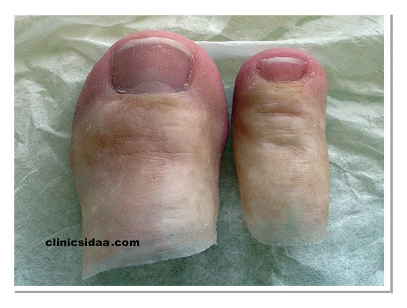 پروتز انگشت پا چیست