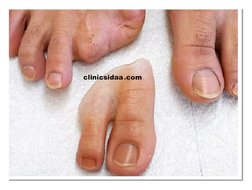 پروتز انگشت پا چه جنسی دارد