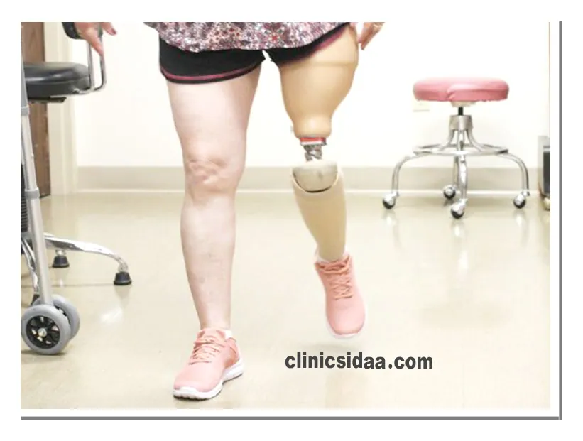 دوام پروتز پا بالای زانو 