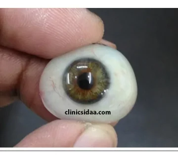 بهترین مرکز ساخت پروتز چشم