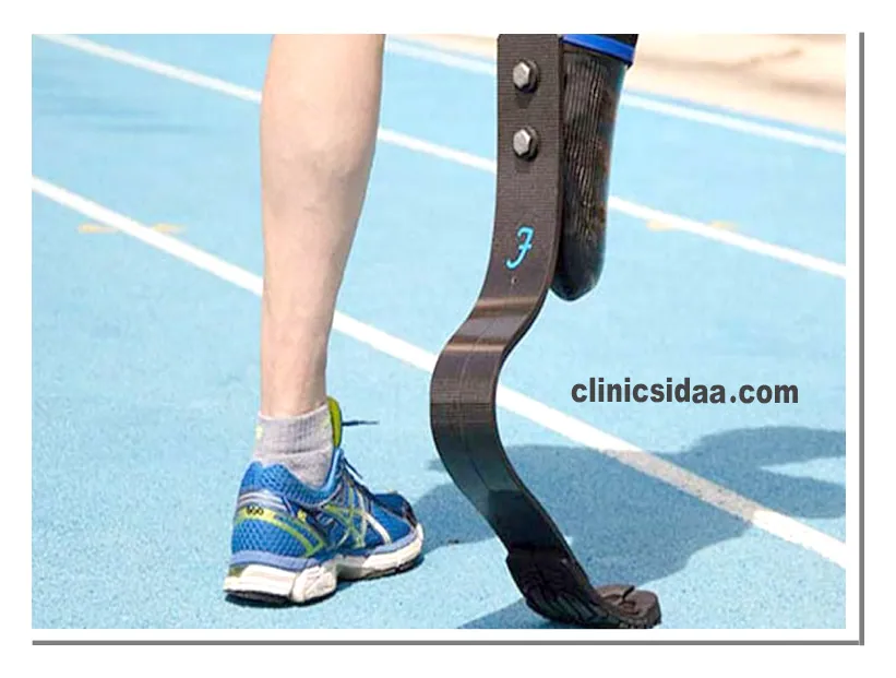 بهترین مرکز پروتز پا