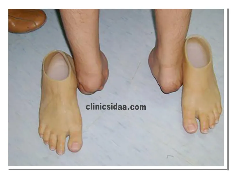 عوامل تاثیر گذار در قیمت پروتز مچ پا