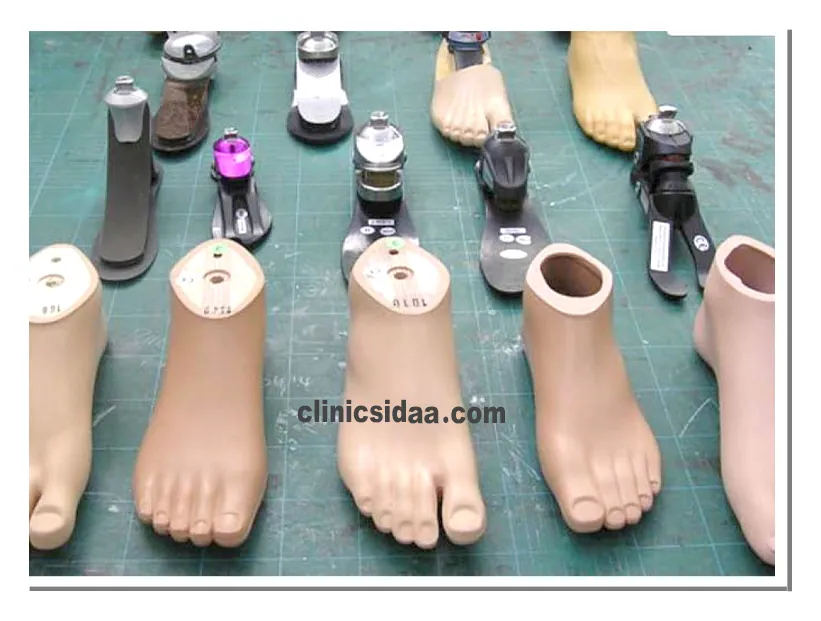 انواع پروتز مچ پا