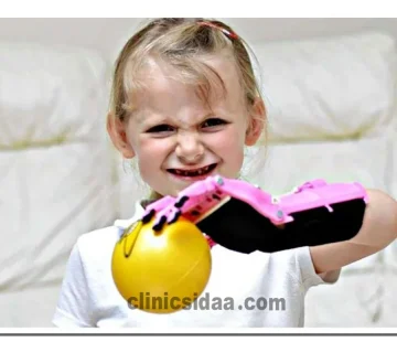 پروتز دست بچه