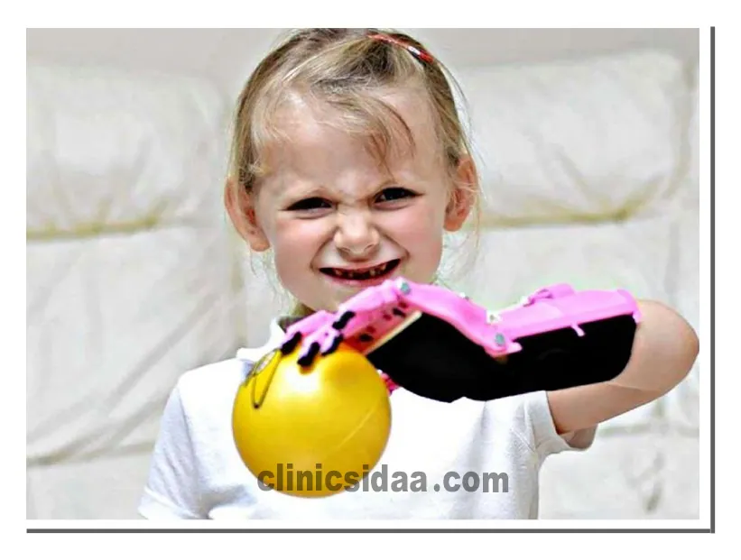 پروتز دست بچه