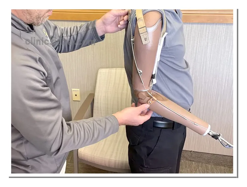 معرفی انواع پروتزهای بالای آرنج و کاربردهای آنها 1 انواع پروتز بالای آرنج