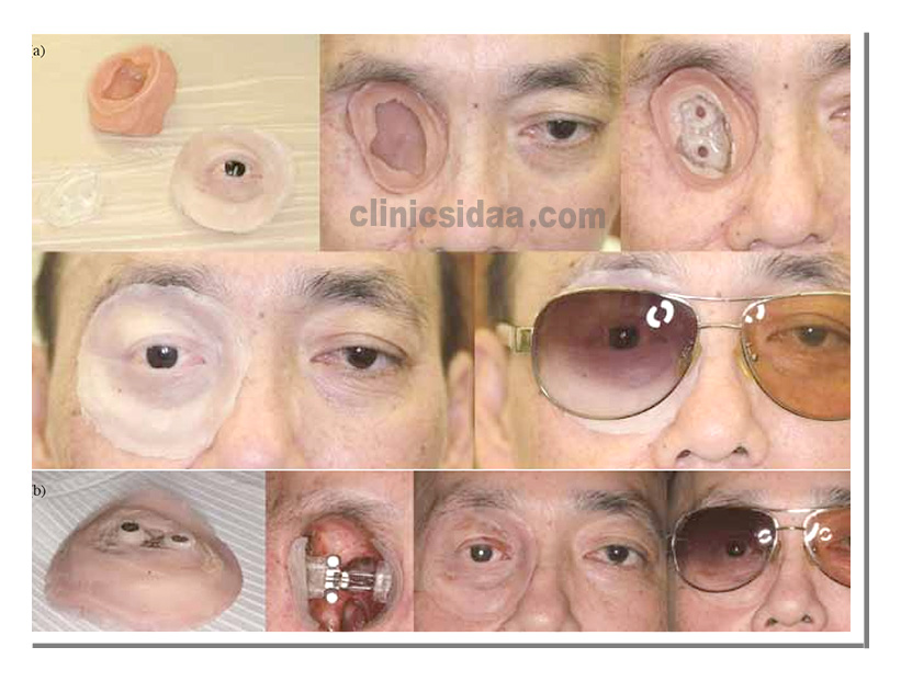 پروتز چشم اوربیتال 