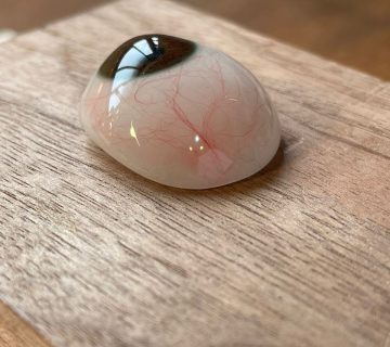 تأثیر پروتز چشم بر کیفیت زندگی بیماران