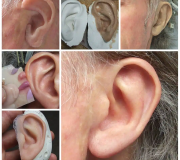 انواع پروتز خارجی