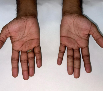 بهترین پزشک پروتز انگشت