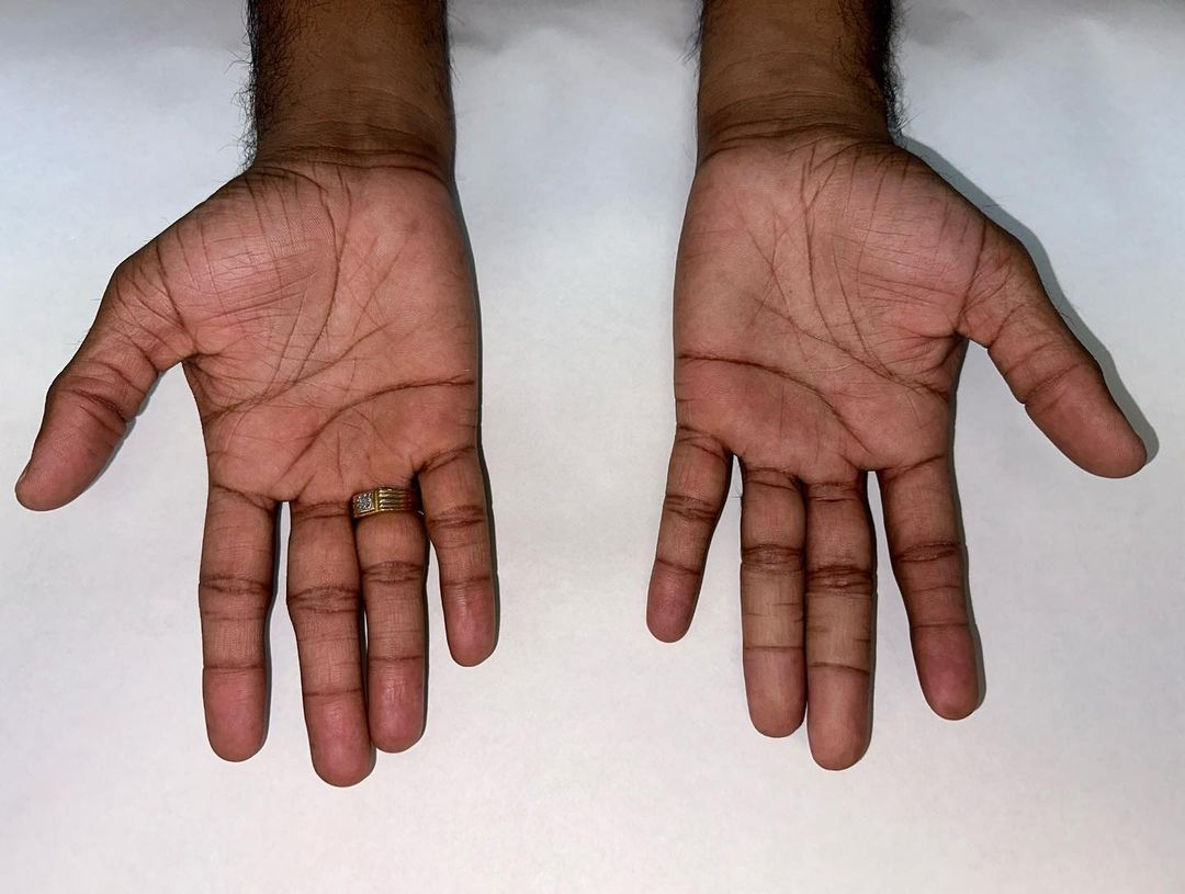 بهترین پزشک پروتز انگشت