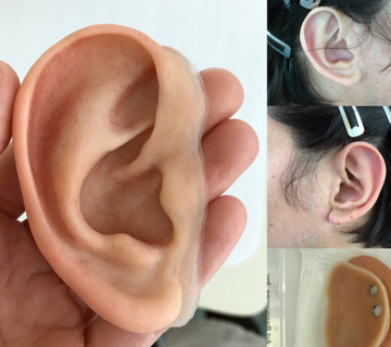 بهترین پزشک پروتز گوش