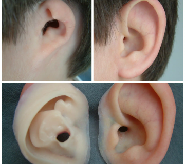 زندگی بعد از پروتز گوش