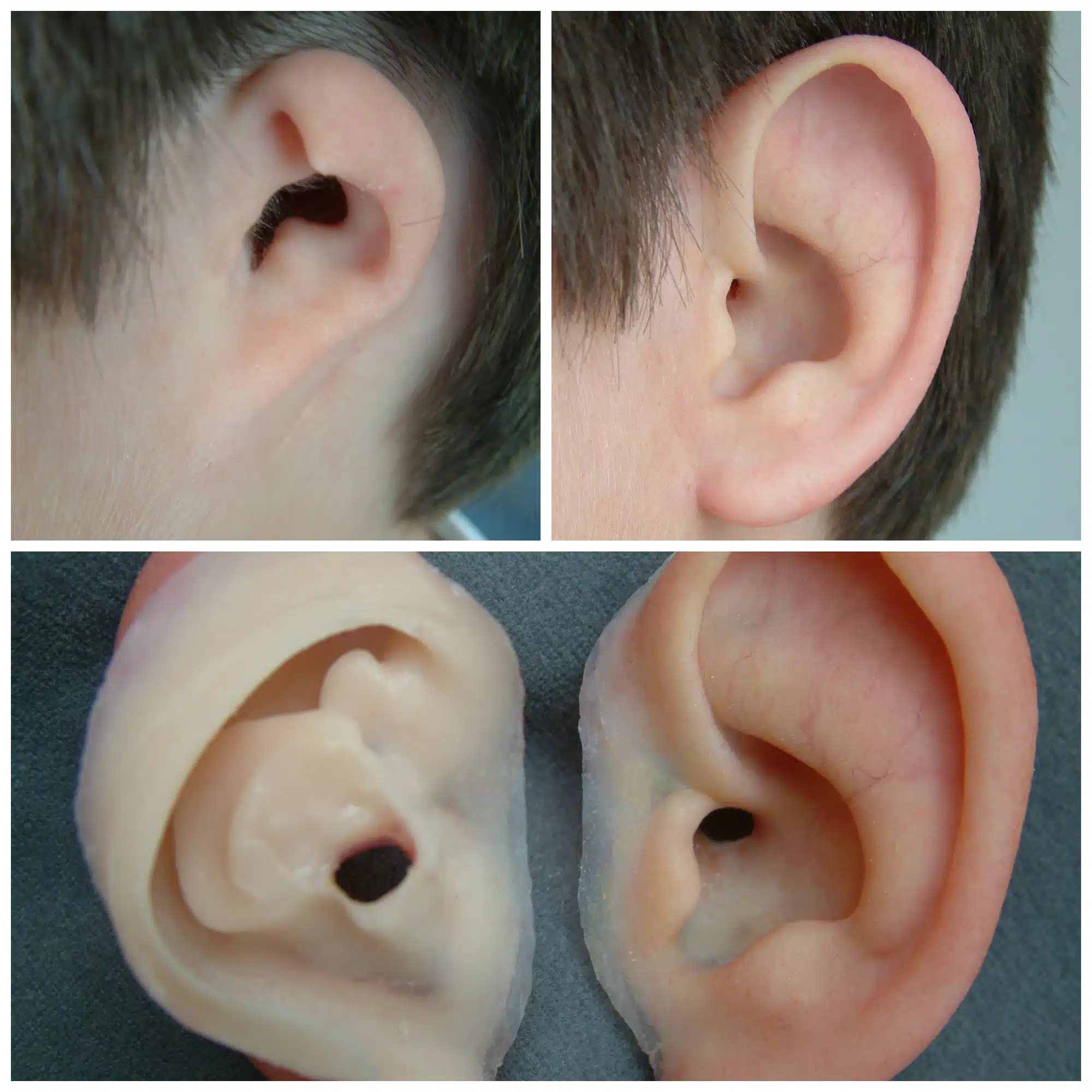 مقایسه زندگی قبل و بعد از پروتز گوش: تأثیرات و تغییرات مهم در کیفیت زندگی 1 زندگی بعد از پروتز گوش