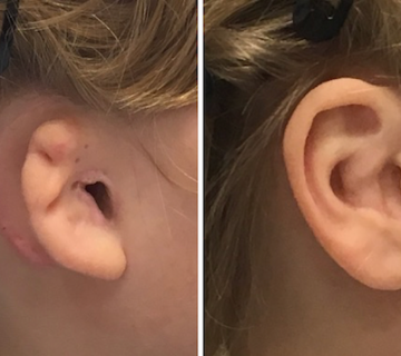 نباید های پروتز گوش