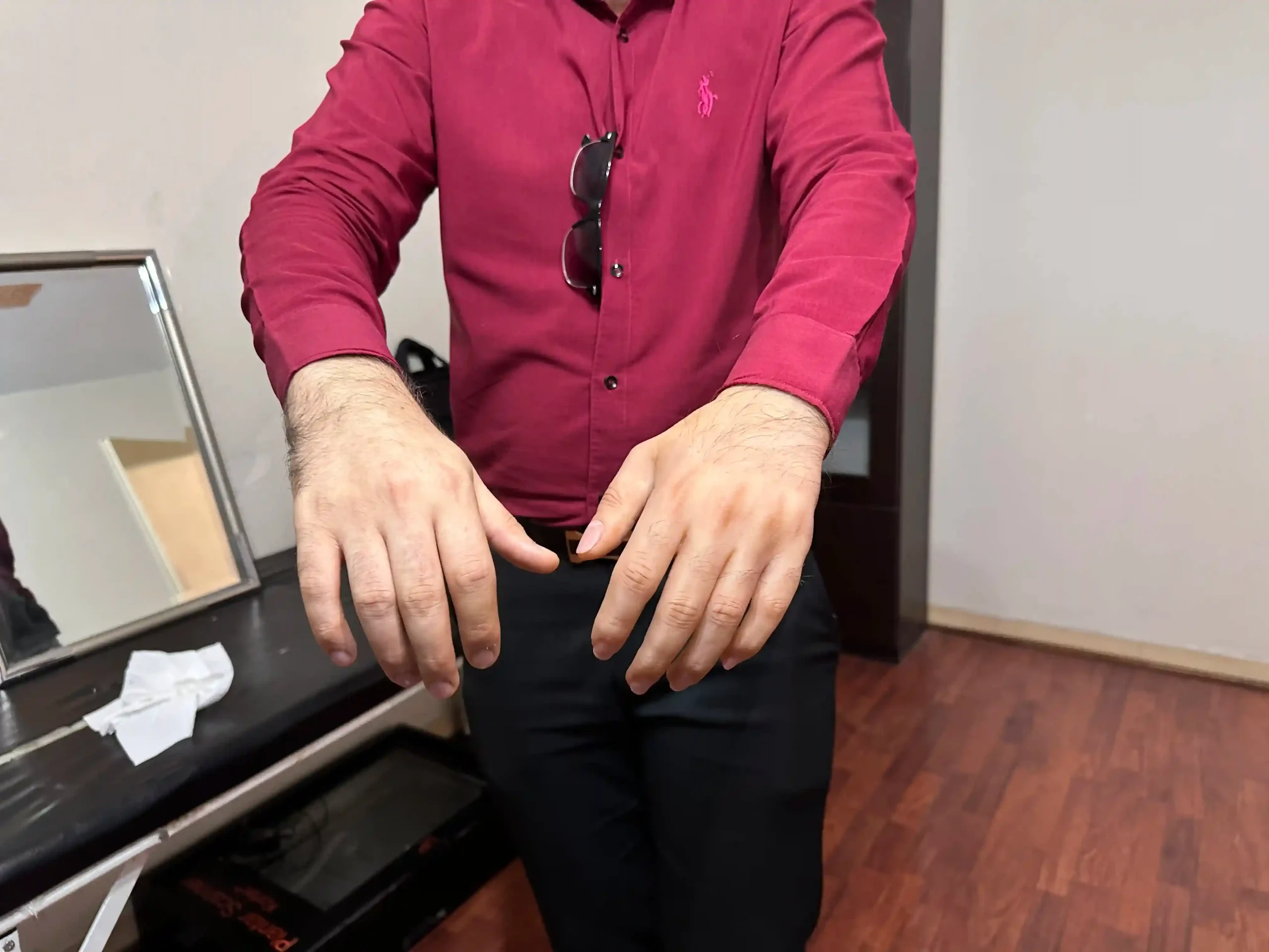 ساخت پروتز زیبایی یک انگشت قطع شده دست