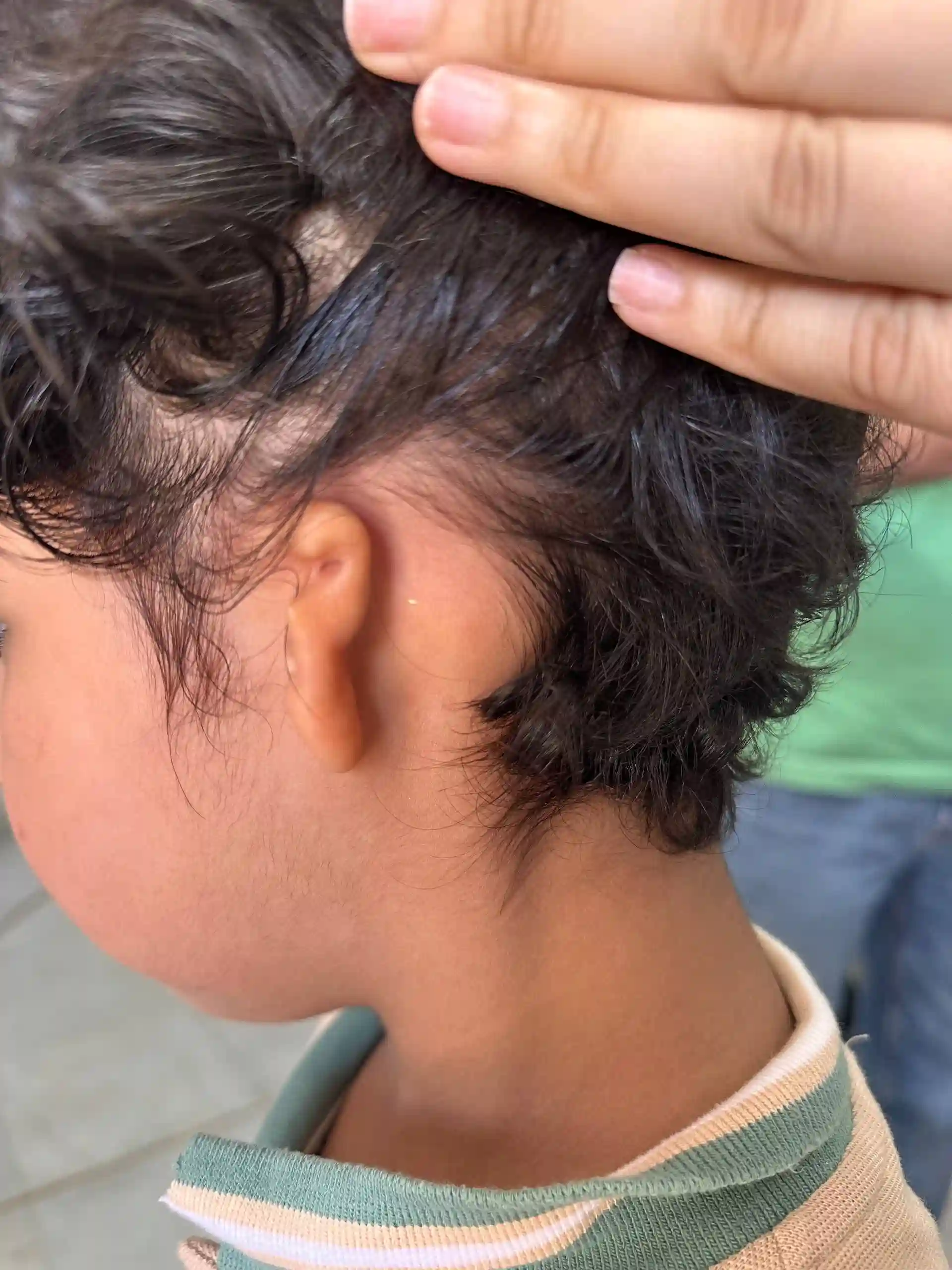 نمونه اول قبل و بعد پروتز گوش سیلیکونی